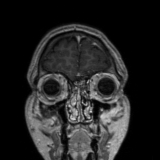 Cerebral venous thrombosis (Radiopaedia 38392-40469 Coronal T1 C+ 79).png