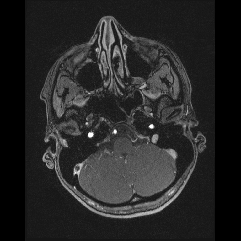 Cerebral venous thrombosis (Radiopaedia 45678-49854 Axial MRV 10).jpg