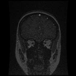 Cerebral venous thrombosis - ulcerative colitis (Radiopaedia 66049-75219 Coronal MRV 92).jpg