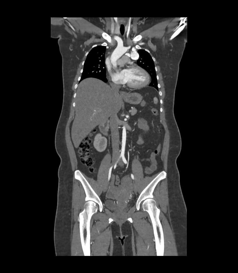 Cervical aortic arch with coarctation and aneurysms (Radiopaedia 44035-47552 C 26).jpg