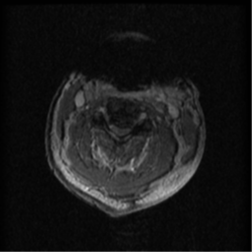 Cervical canal stenosis with cord compression (Radiopaedia 34114-35374 Axial Gradient Echo 63).png