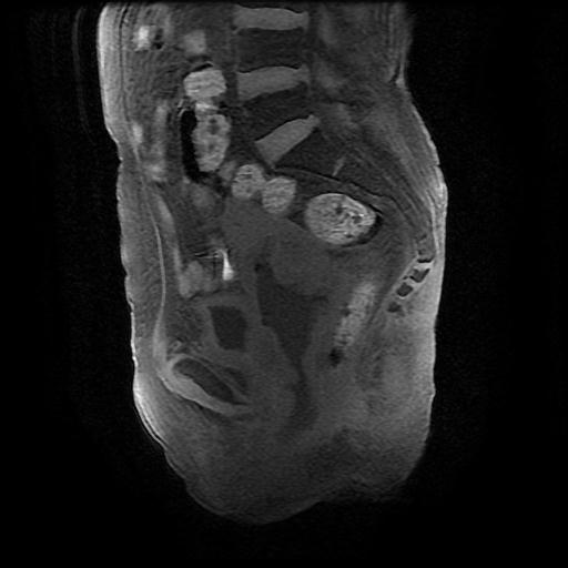 File:Cervical carcinoma (Radiopaedia 78847-91705 Sagittal T1 fat sat 8).jpg