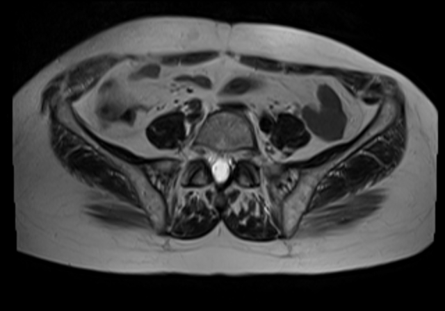 File:Cervical carcinoma (Radiopaedia 88312-104943 Sagittal T1 3).jpg