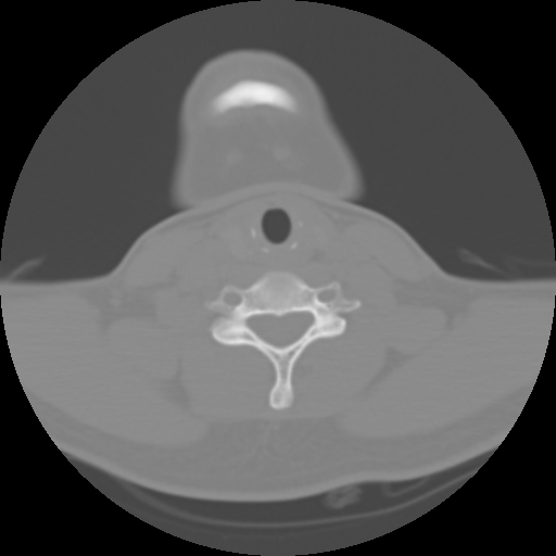 Cervical rib (Radiopaedia 71110-81363 Axial non-contrast 39).jpg