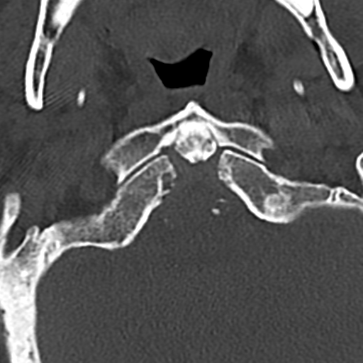 File:Cervical spine fracture - chalk stick (Radiopaedia 39116-41323 Axial bone window 11).png