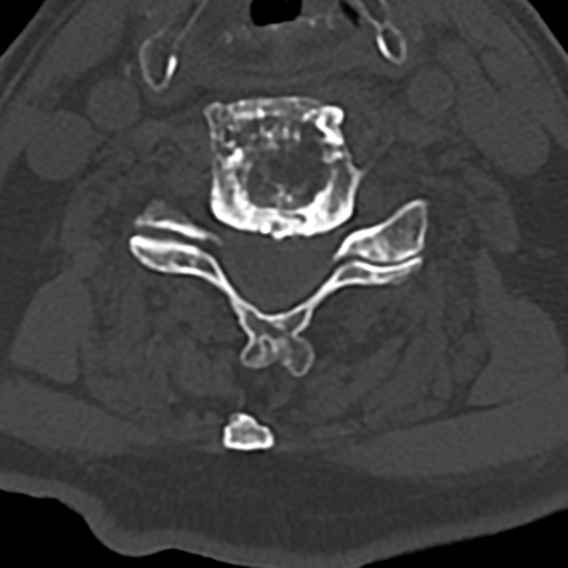 File:Cervical spine fracture - chalk stick (Radiopaedia 39116-41323 Axial bone window 57).png