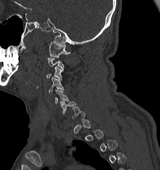Cervical spine trauma with tear drop fracture and perched facet joint (Radiopaedia 53989-60127 Sagittal bone window 135).jpg