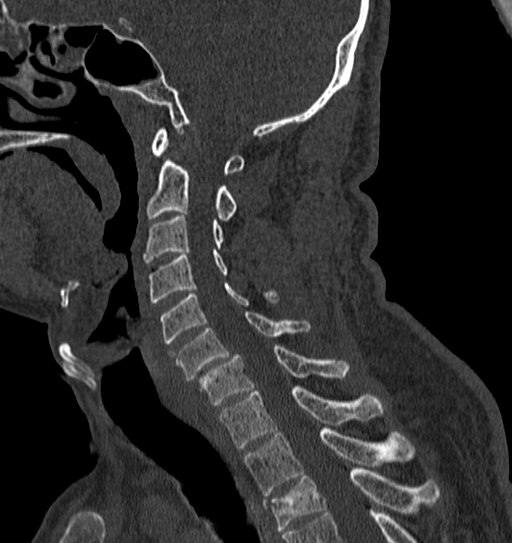 Cervical spine trauma with tear drop fracture and perched facet joint (Radiopaedia 53989-60127 Sagittal bone window 70).jpg