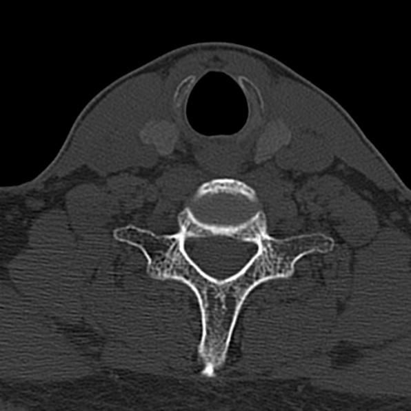 Cervical spondylodiscitis (Radiopaedia 28057-29489 Axial bone window 59).jpg