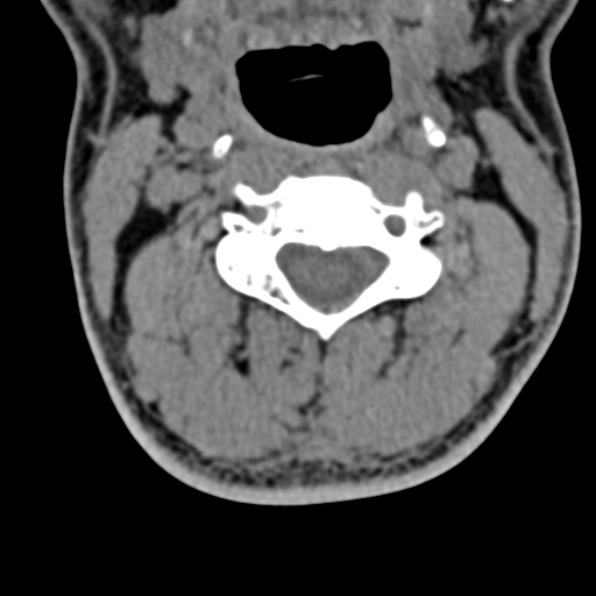 Cervical spondylodiscitis (Radiopaedia 28057-29489 Axial non-contrast 33).jpg