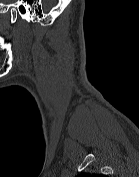 File:Cervical spondylodiscitis (Radiopaedia 28057-29489 Sagittal bone window 7).jpg