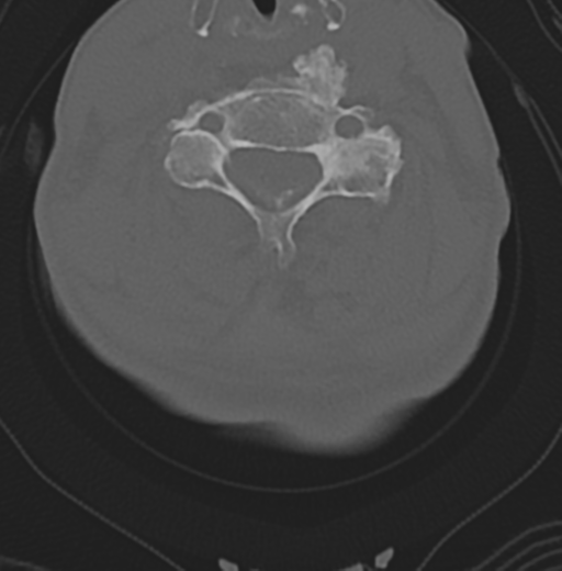 Cervical spondylolysis (Radiopaedia 49616-54811 Axial bone window 33).png