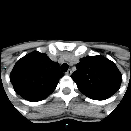 Cervical thymic cyst (Radiopaedia 88632-105335 Axial non-contrast 13).jpg