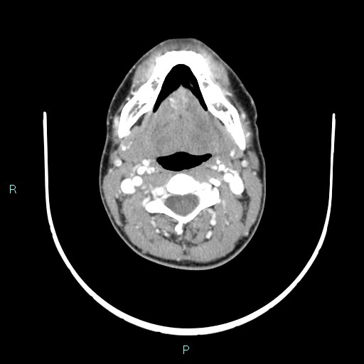 Cervical thymic cyst (Radiopaedia 88632-105335 B 76).jpg
