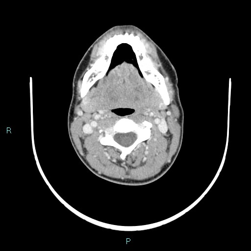 File:Cervical thymic cyst (Radiopaedia 88632-105335 C 77).jpg