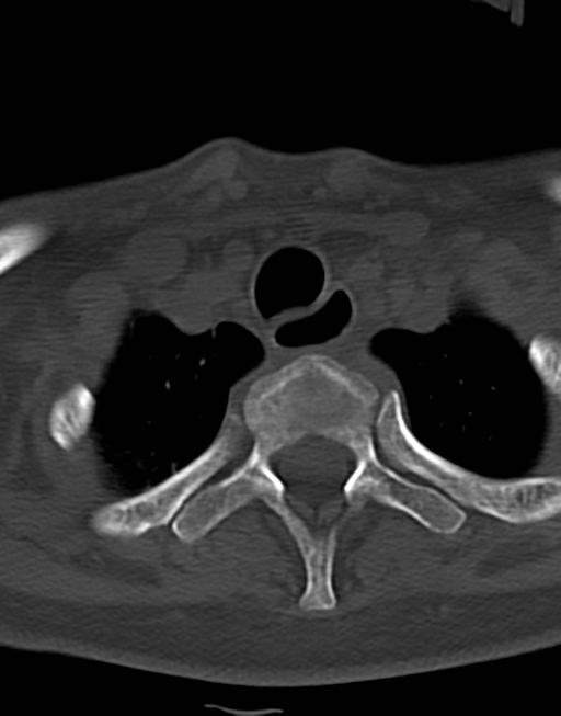 Cervical tuberculous spondylitis (Radiopaedia 39149-41365 Axial bone window 49).png