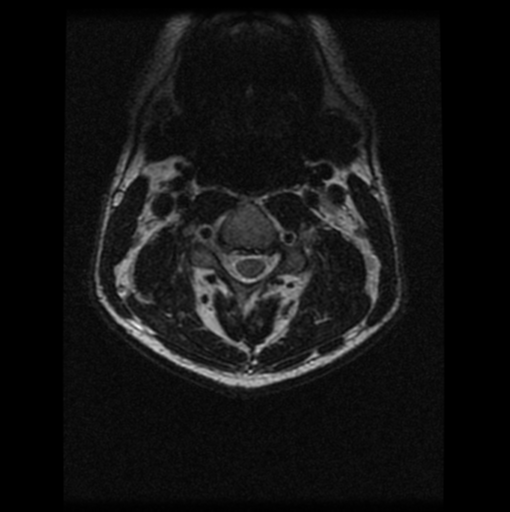 File:Cervical vertebrae metastasis (Radiopaedia 78814-91667 Axial T2 16).png
