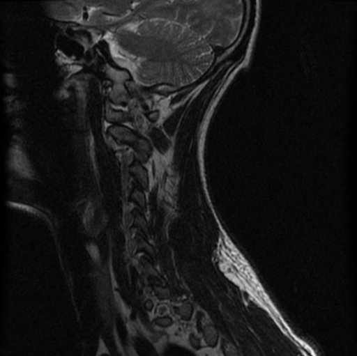File:Cervical vertebrae metastasis (Radiopaedia 78814-91667 Sagittal T2 2).png