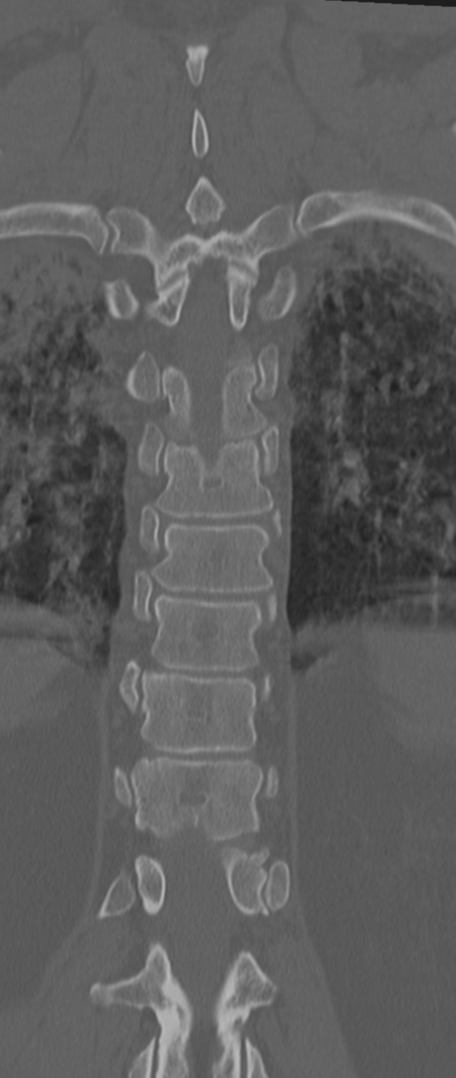 Chance fracture (Radiopaedia 33854-35020 Coronal bone window 59).png