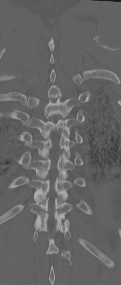 Chance fracture (Radiopaedia 33854-35020 Coronal bone window 69).png
