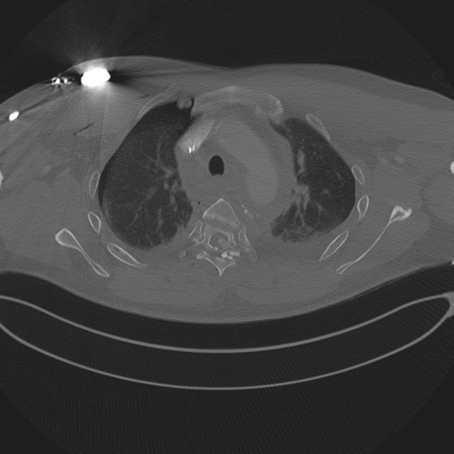 Chest multitrauma - aortic injury (Radiopaedia 34708-36147 Axial bone window 88).png
