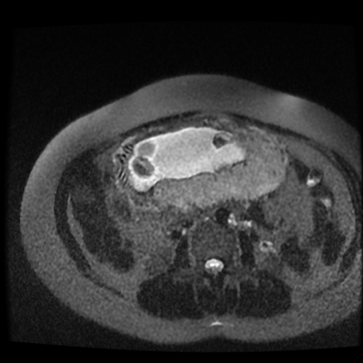 Chiari II malformation - fetal MRI (Radiopaedia 68099-77581 Axial T2-SSFSE 1).jpg