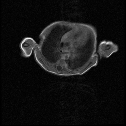 File:Chiari II malformation with spinal meningomyelocele (Radiopaedia 23550-23652 Axial T1 4).jpg