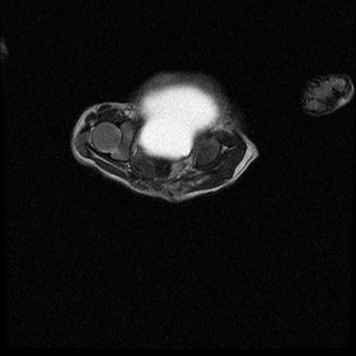 File:Chiari II malformation with spinal meningomyelocele (Radiopaedia 23550-23652 Axial T2 18).jpg