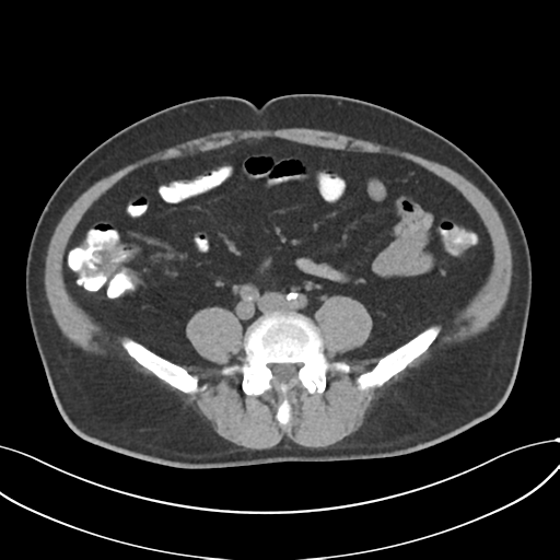 Cholecystitis with focal perforation and hepatic abscess (Radiopaedia 37189-38945 Axial non-contrast 55).png