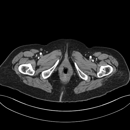 File:Cholecystoduodenal fistula due to calculous cholecystitis with gallstone migration (Radiopaedia 86875-103077 A 80).jpg