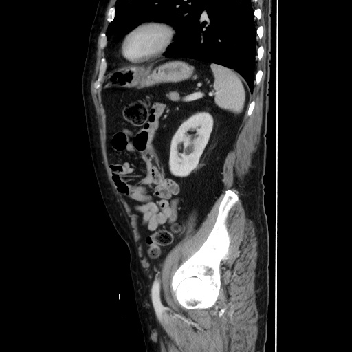 Choledocholiathiasis with normal caliber common bile duct (Radiopaedia 75368-86632 D 116).jpg