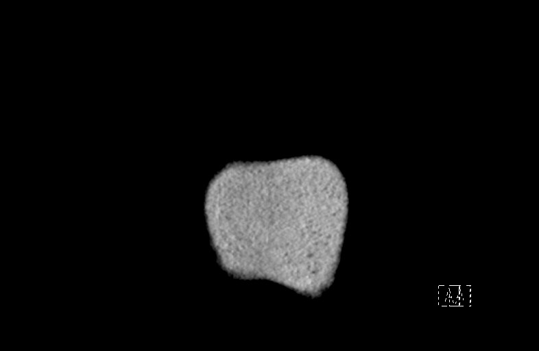 File:Choledocolithiasis - passed stones (Radiopaedia 72030-82516 B 1).jpg