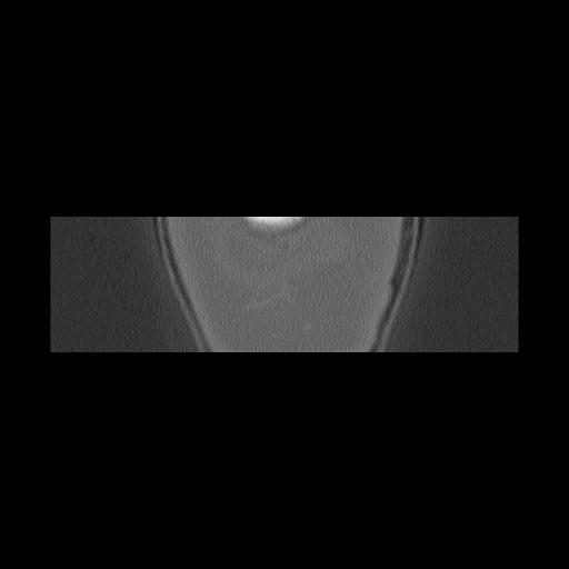 Cholesteatoma (Radiopaedia 84946-100455 Coronal bone window 174).jpg