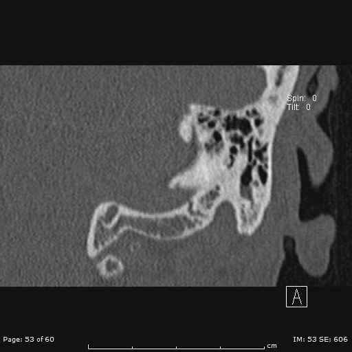 Cholesteatoma - external auditory canal (Radiopaedia 88452-105096 Coronal bone window 53).jpg