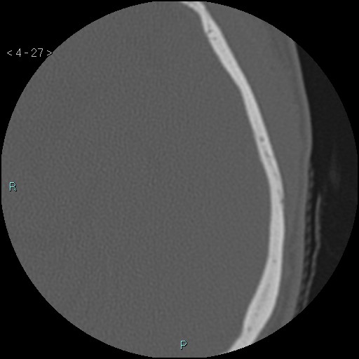 Cholesterol granuloma of the petrous apex (Radiopaedia 64358-73141 Axial bone window 13).jpg