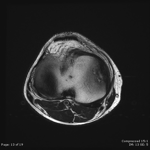 File:Chondroblastoma (Radiopaedia 25725-25891 Axial T2 13).jpg