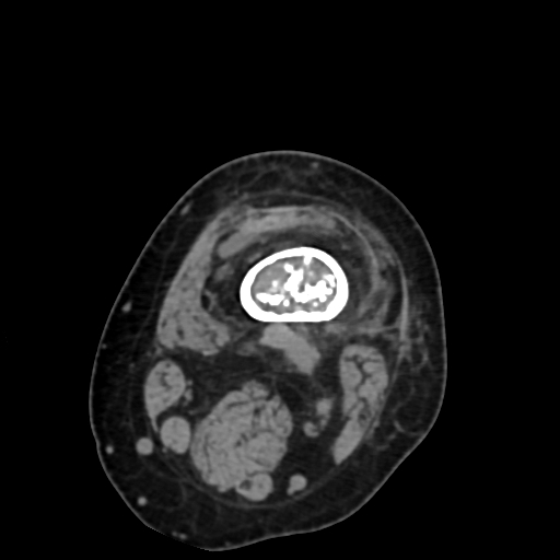 Chondrosarcoma - femur (Radiopaedia 64187-72954 Axial non-contrast 18).jpg
