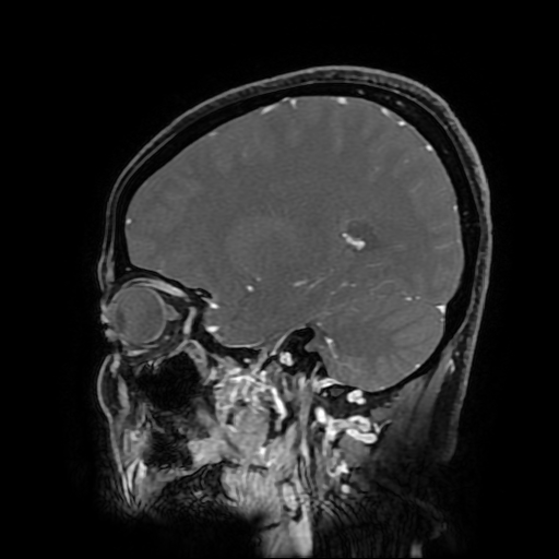 File:Chordoid glioma of third ventricle (Radiopaedia 91612-109340 F 140).jpg