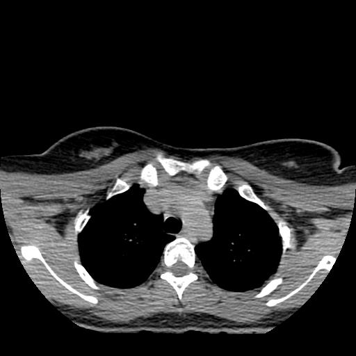 File:Choriocarcinoma of ovary with cerebral and pulmonary metastases (Radiopaedia 25983-26119 Axial non-contrast 99).jpg