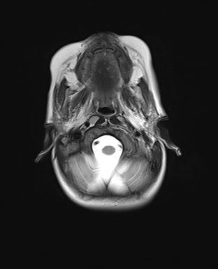 File:Choroid plexus papilloma (Radiopaedia 84612-100019 Axial T2 3).jpg