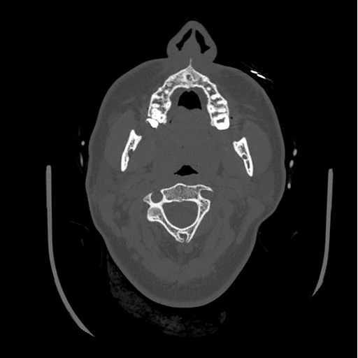 Choroid plexus papilloma extending into the cerebellopontine angle cistern (Radiopaedia 85941-101833 Axial bone window 2).png