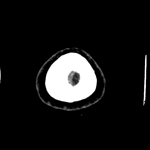 Choroid plexus xanthogranulomas (Radiopaedia 51621-57408 Axial non-contrast 115).jpg