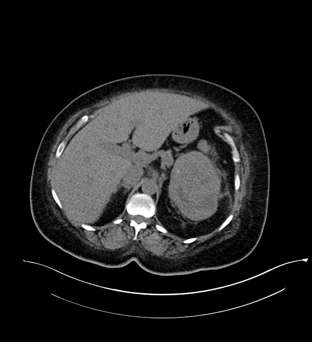Chromophobe renal cell carcinoma (Radiopaedia 84239-99519 Axial non-contrast 55).jpg