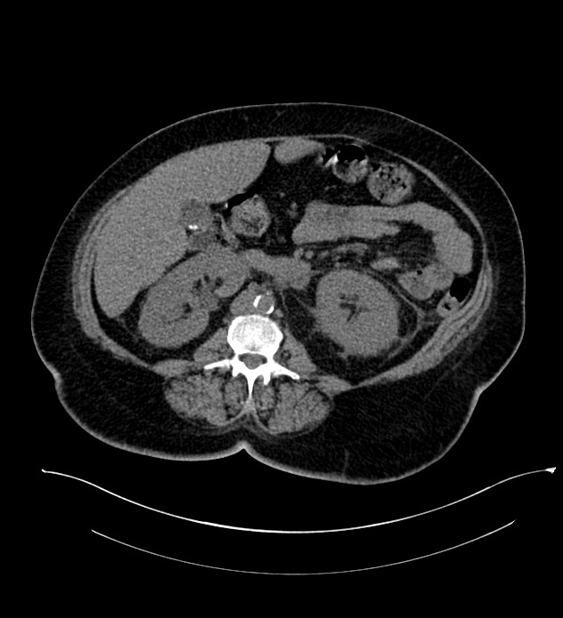 Chromophobe renal cell carcinoma (Radiopaedia 84239-99519 Axial non-contrast 84).jpg