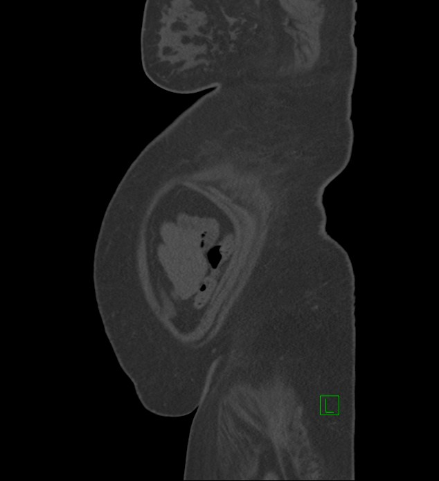 Chromophobe renal cell carcinoma (Radiopaedia 84239-99519 Sagittal bone window 3).jpg