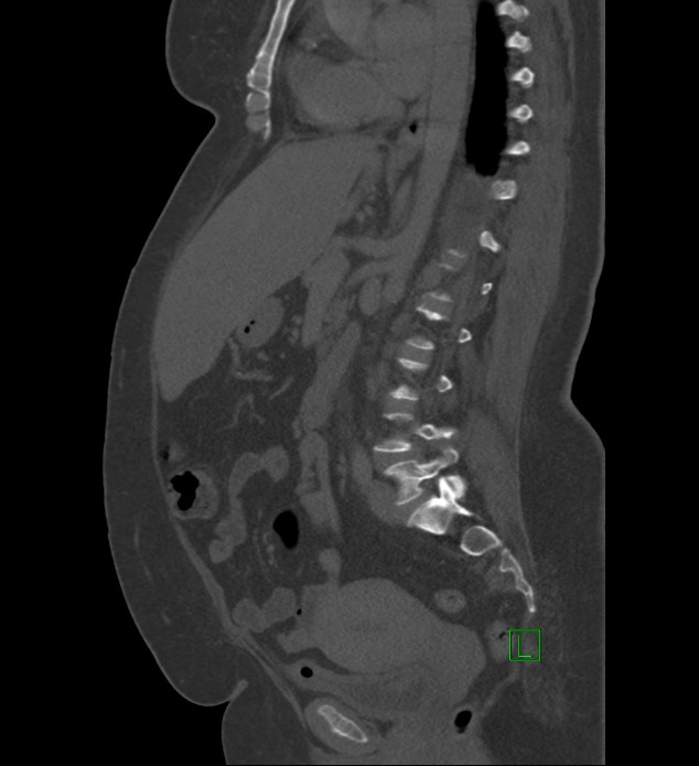 Chromophobe renal cell carcinoma (Radiopaedia 84239-99519 Sagittal bone window 51).jpg