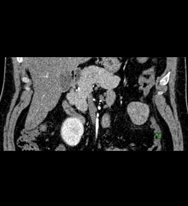 Chromophobe renal cell carcinoma (Radiopaedia 84286-99573 E 14).jpg