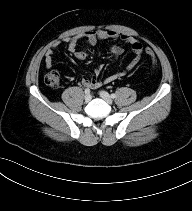 Chromophobe renal cell carcinoma (Radiopaedia 84286-99573 G 50).jpg