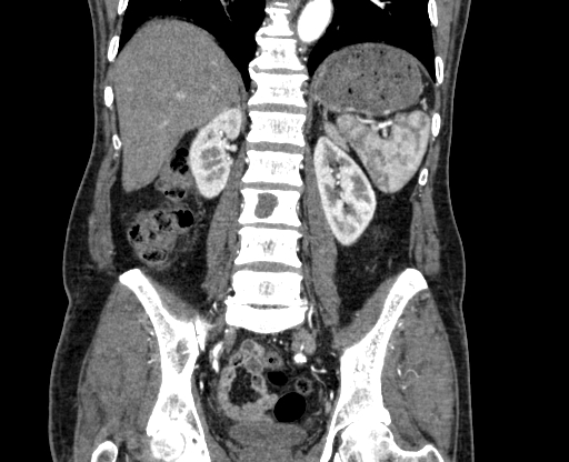 Chronic contained rupture of abdominal aortic aneurysm with extensive erosion of the vertebral bodies (Radiopaedia 55450-61901 D 53).jpg