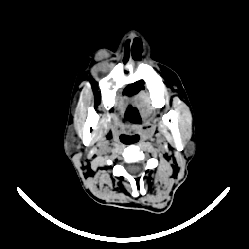 File:Chronic invasive fungal sinusitis with intraorbital and intracranial extension (Radiopaedia 56387-63046 Axial non-contrast 25).jpg